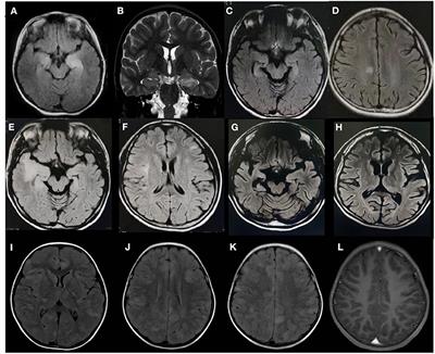 Case Report: Autoimmune Encephalitis Associated With Anti-glutamic Acid Decarboxylase Antibodies: A Pediatric Case Series